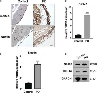 Nestin Promotes Peritoneal Fibrosis by Protecting HIF1-α From Proteasomal Degradation